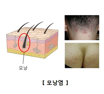 모낭염 치료 - 에스로반(무피로신) 제대로 쓰는 법 2 image 18