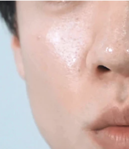 개기름 제거엔 디페린겔(여드름 연고 아다팔렌) 5 image 33
