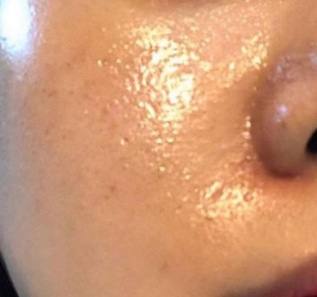 개기름 제거엔 디페린겔(여드름 연고 아다팔렌) 7 image 35