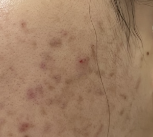 색소침착 없애는 법: 멜라노사 크림 효과와 사용법 3 image 75