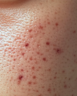 색소침착 없애는 법: 멜라노사 크림 효과와 사용법 4 image 76