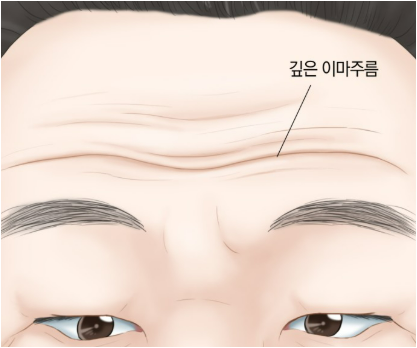 굵은 주름 고민? 투앤티(Tu&ti)로 피부 탄력 되찾기 5 깊은 이마 주름